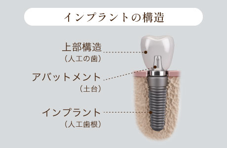 インプラントの構造
