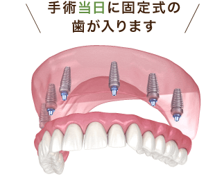 All-on-4/6・プロアーチ4/6