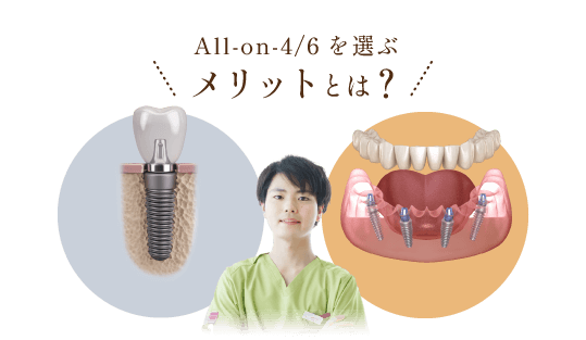 All-on-4/6を選ぶメリットとは？