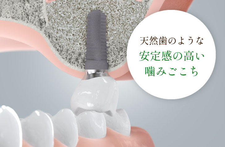 天然歯のような安定感の高い噛みごこち