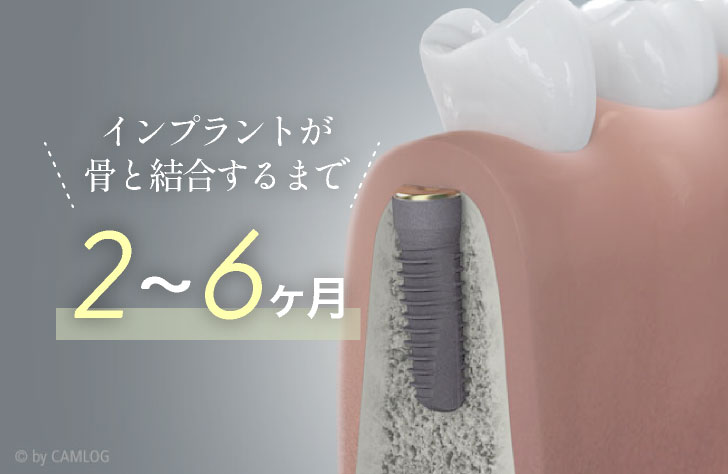インプラントが骨と結合するまで2~6ヶ月