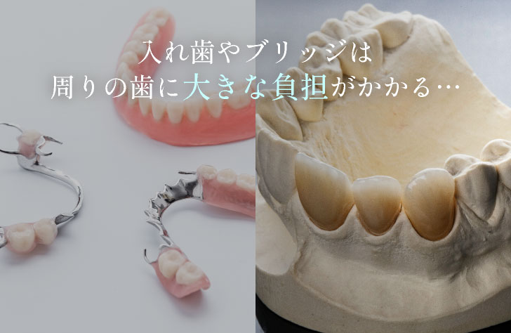 入れ歯やブリッジは周りの歯に大きな負担がかかる…